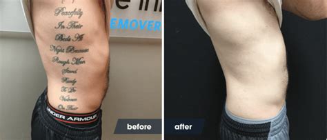 healing after laser tattoo removal.
